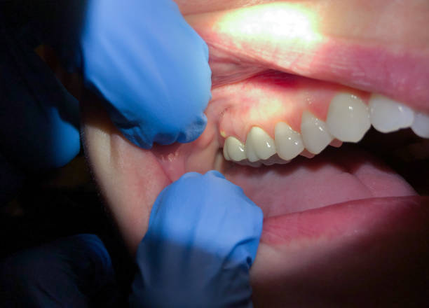 Best Emergency Treatment for Toothache in Bon Secour, AL